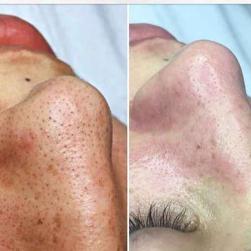 Limpeza de pele  (Imagem Principal)