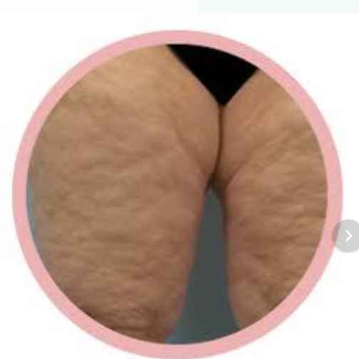 Estrias (Imagem Principal)